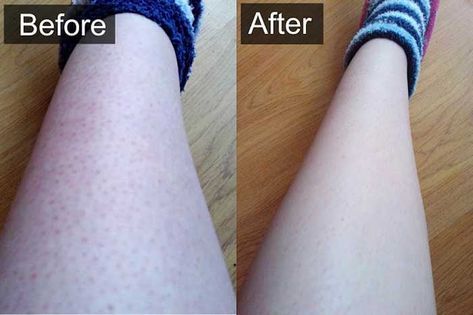 How to Get Rid of Strawberry Legs Fast (with Before & After Pictures) -   17 how to get rid of strawberry legs fast ideas