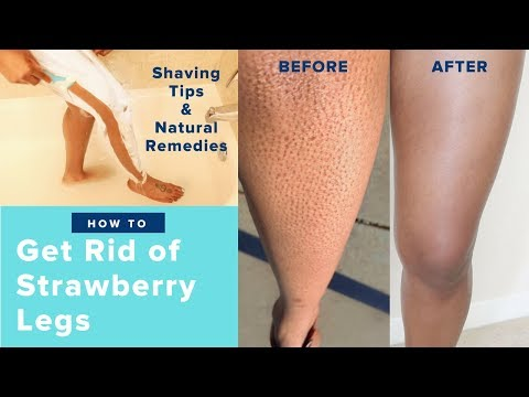 How to Get Rid of Strawberry Legs Fast LIKE A BOSS! | Easy Regimen & AT HOME REMEDIES -   17 how to get rid of strawberry legs fast ideas