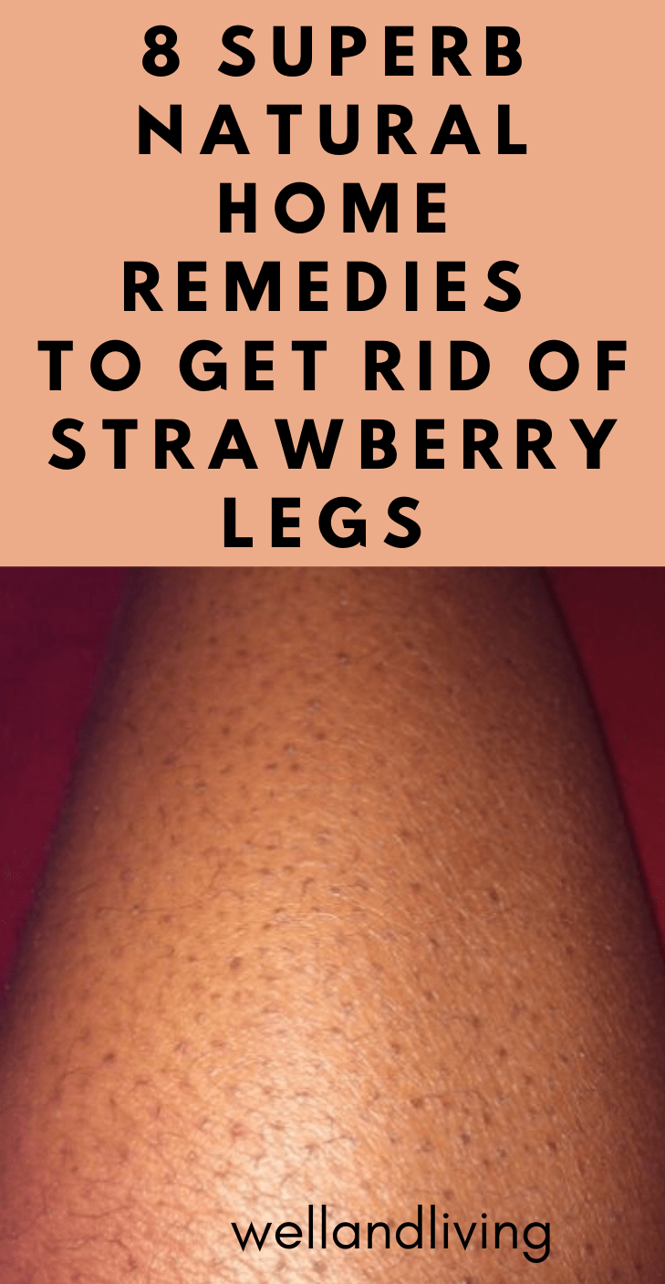 How to Get Rid Of Strawberry Legs Fast At Home: 8 Superb Natural Home Remedies - Well and Living -   17 how to get rid of strawberry legs fast ideas
