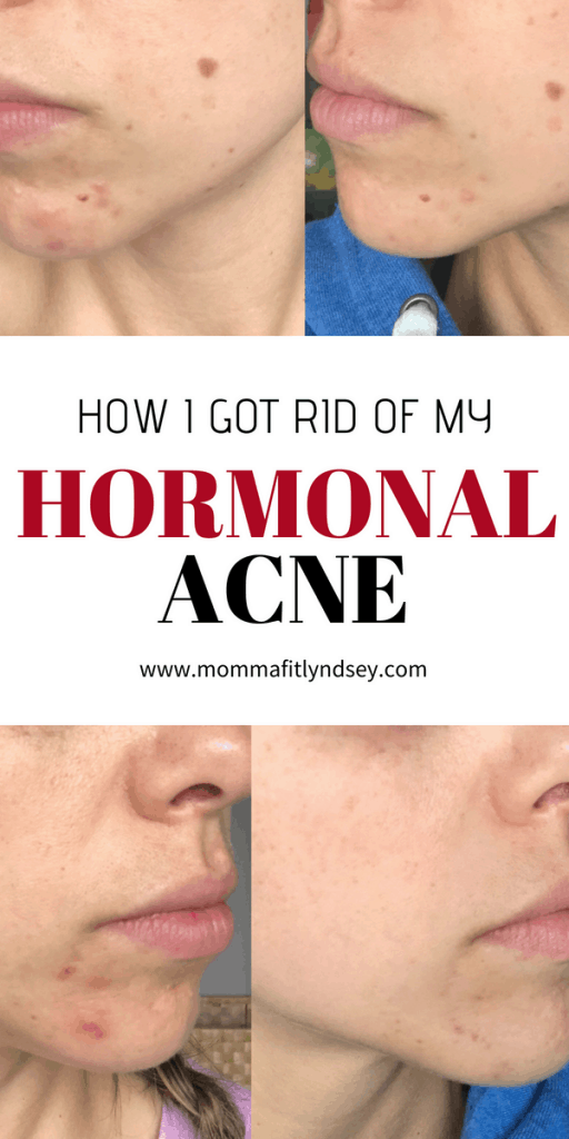 Treat Hormonal Acne with Gut Healing Foods - Momma Fit Lyndsey -   19 how to get rid of acne ideas