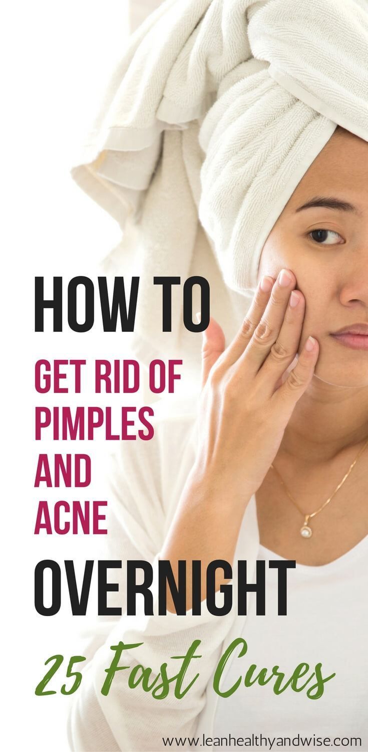 How to Get Rid of Pimples and Acne Overnight: 25 Fast Cures -   19 how to get rid of acne ideas