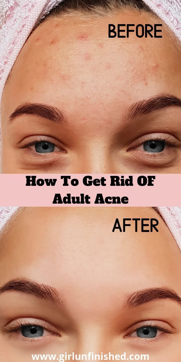 Getting Rid of Adult Acne: A Beginner's Guide -   19 how to get rid of acne ideas