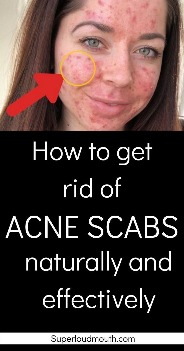 19 how to get rid of acne ideas