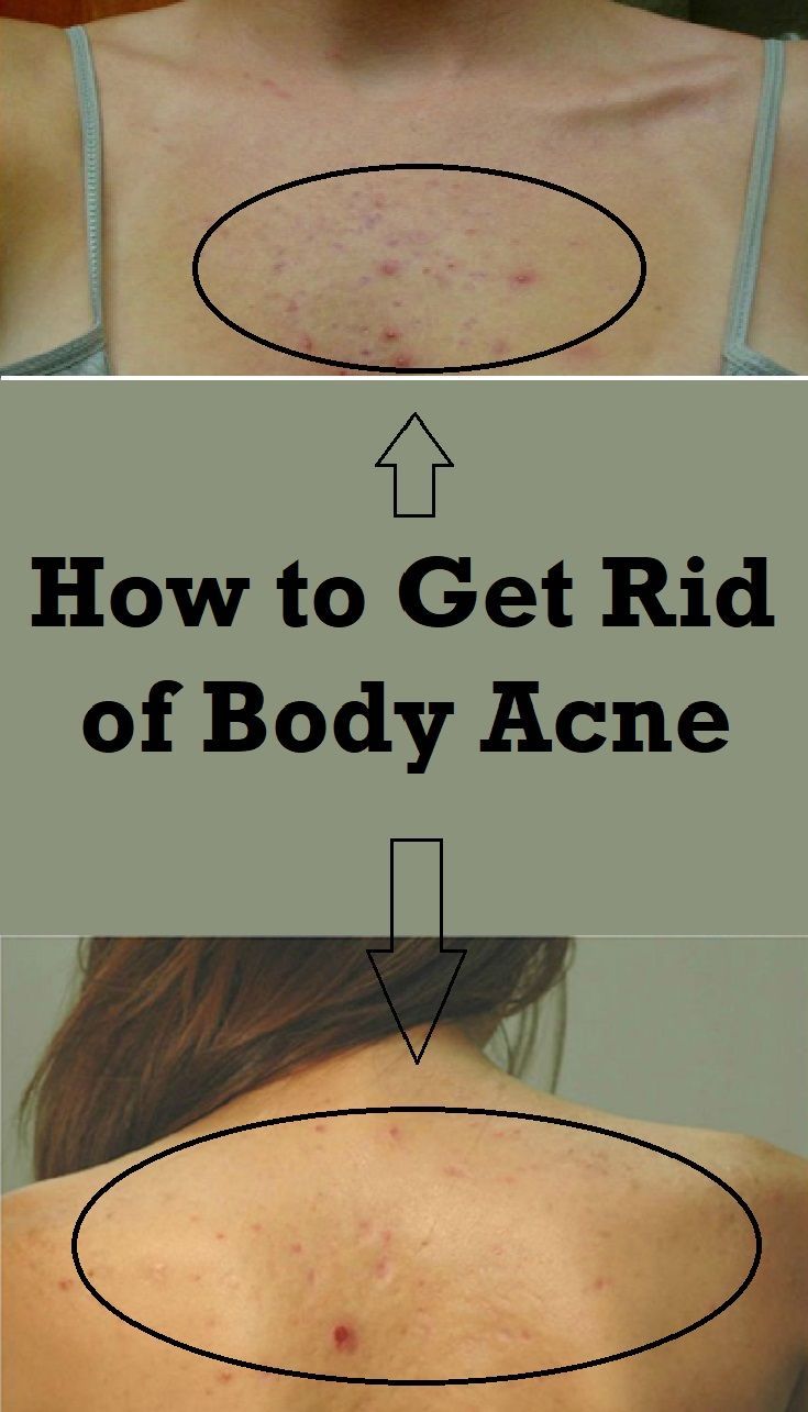 How to Get Rid of Body Acne -   19 how to get rid of acne ideas