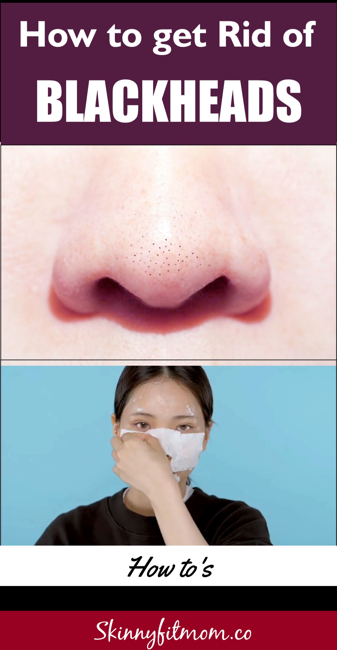 How to Remove Blackheads: The Best AT-Home Treatment -   19 how to get rid of acne ideas