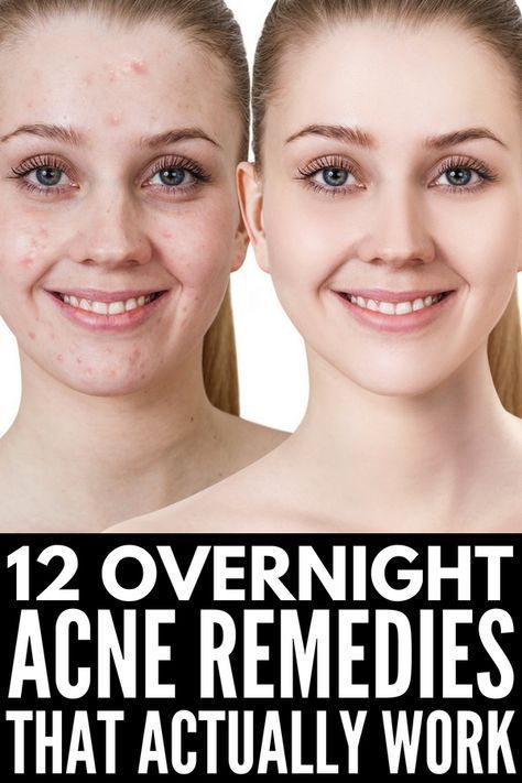 How to Get Rid of Acne Overnight: 12 Remedies that Work -   19 how to get rid of acne ideas