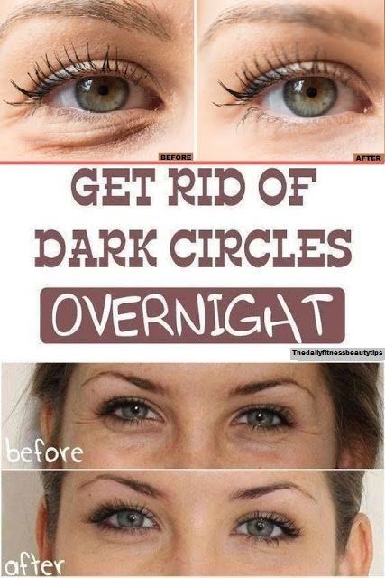 How To Get Rid Of Dark Circles Overnight? -   25 how to get rid of bags under eyes ideas