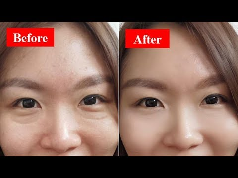 How To Get Rid Of Your Eye Bags Fast & Naturally At Home! -   25 how to get rid of bags under eyes ideas