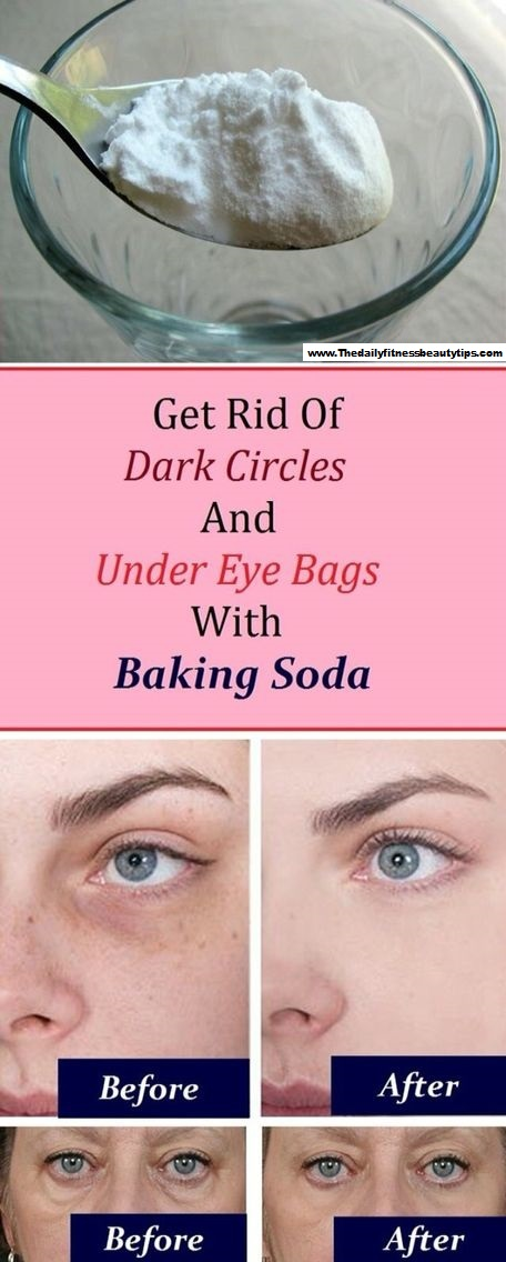 How To Get Rid Of Dark Circles & Under Eye Bags With Baking Soda? -   25 how to get rid of bags under eyes ideas