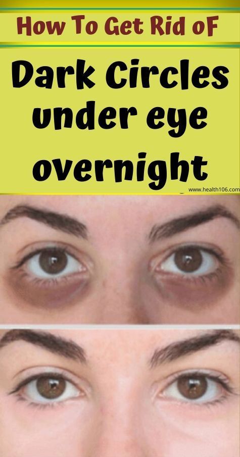 How to get rid of dark circles under eyes overnight -   25 how to get rid of bags under eyes ideas
