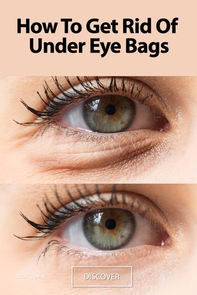 How To Get Rid Of Under Eye Bags: The Best 10 Tips -   25 how to get rid of bags under eyes ideas